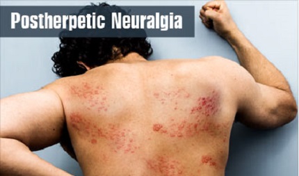 KNOW ABOUT POSTHERPETIC NEURALGIA IN A NUTSHELL