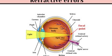 type of refrective error featured image